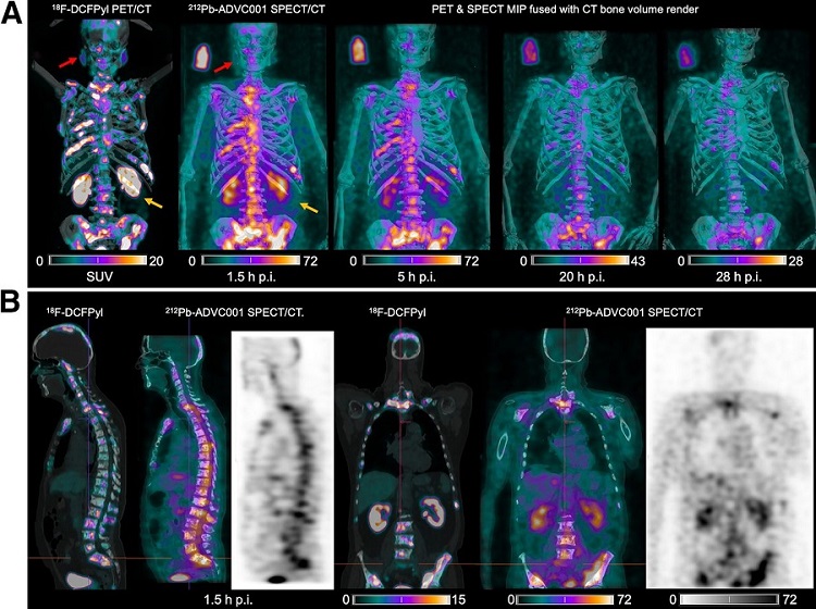 Image: The new SPECT/CT technique demonstrated impressive biomarker identification (Journal of Nuclear Medicine: doi.org/10.2967/jnumed.123.267189)